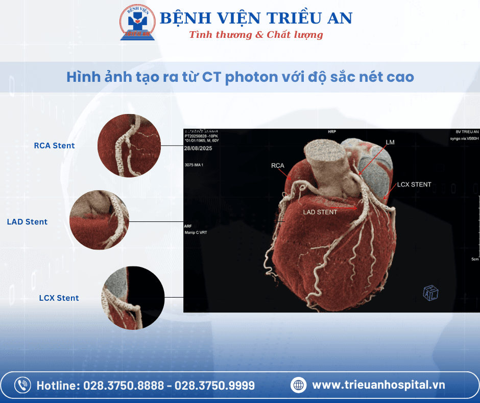 CT PHOTON – LỰA CHỌN MỚI CHO NGƯỜI BỆNH MẠCH VÀNH