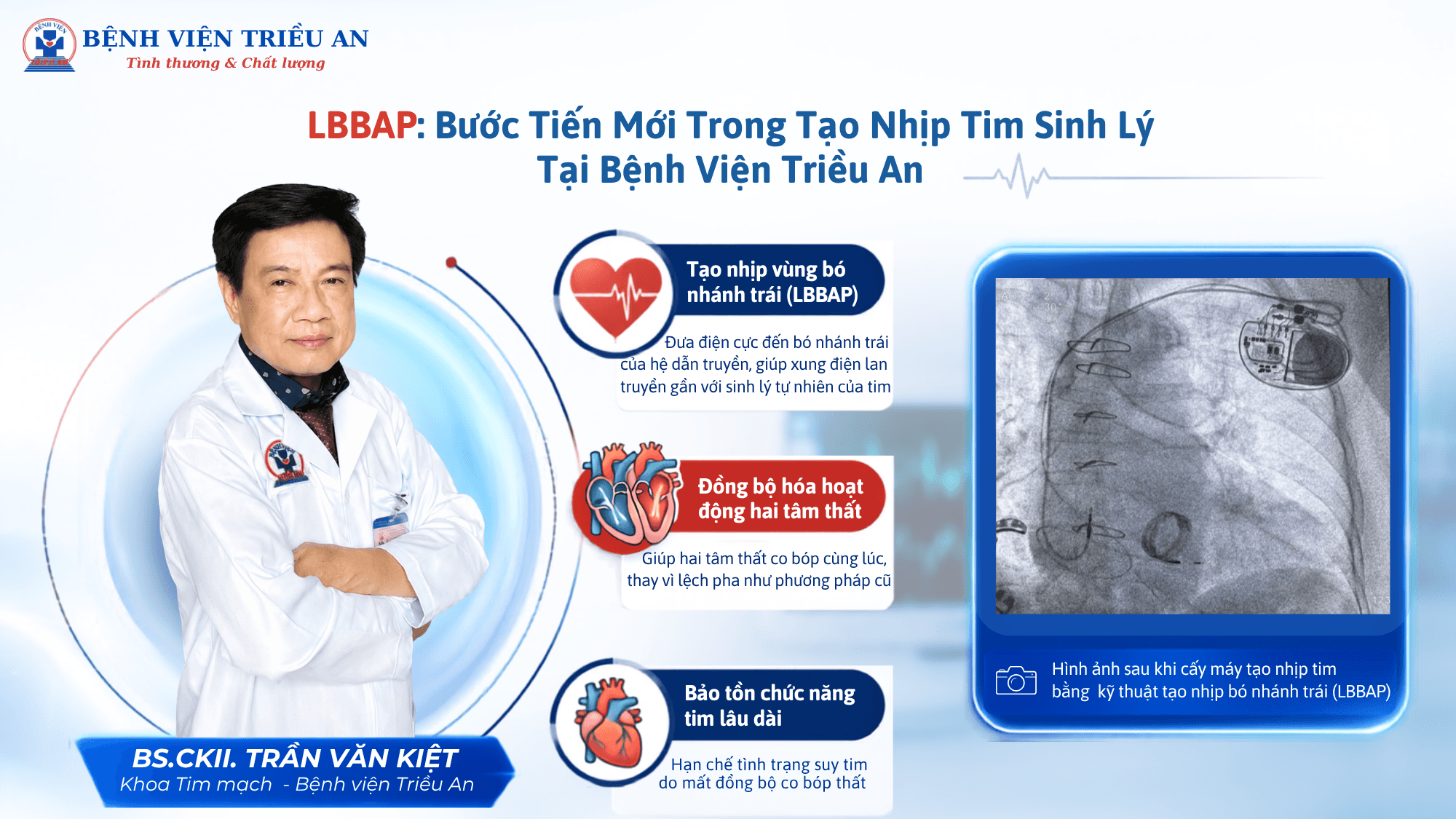 ỨNG DỤNG KỸ THUẬT TẠO NHỊP BÓ NHÁNH TRÁI (LBBAP) TRONG ĐIỀU TRỊ RỐI LOẠN NHỊP TIM
